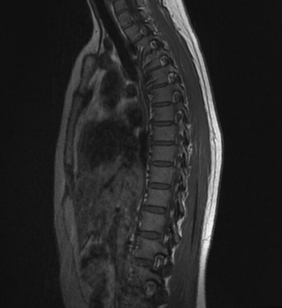 File:Normal thoracic spine MRI (Radiopaedia 41033-43781 Sagittal T1 5).jpg
