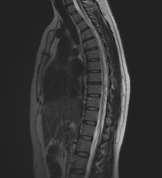 File:Normal thoracic spine MRI (Radiopaedia 41033-43781 Sagittal T2 6).jpg