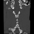 Normal trauma cervical spine (Radiopaedia 41017-43760 Coronal bone window 27).png