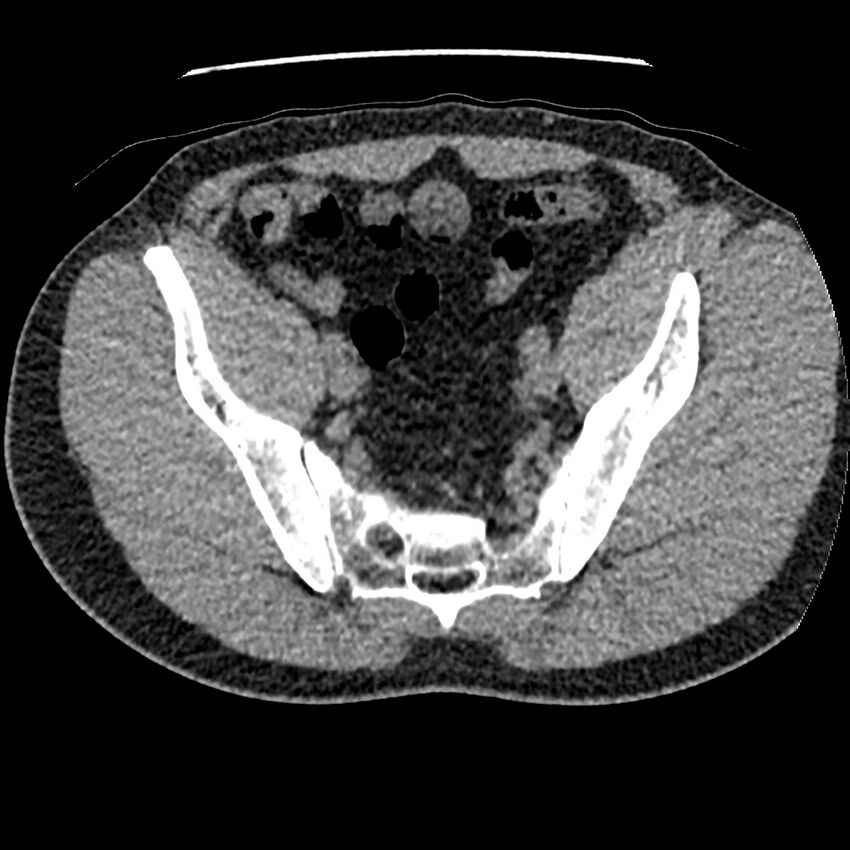 Obstructing ureteric calculus and ureteric anatomy (Radiopaedia 62730-71042 Axial non-contrast 132).jpg