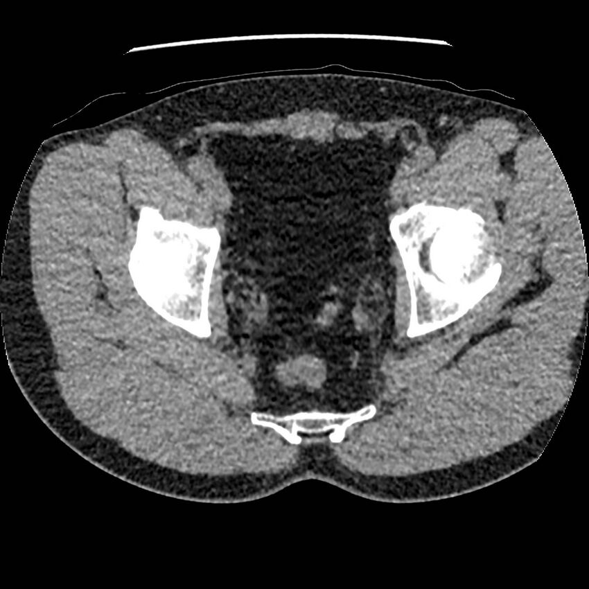 Obstructing ureteric calculus and ureteric anatomy (Radiopaedia 62730-71042 Axial non-contrast 153).jpg