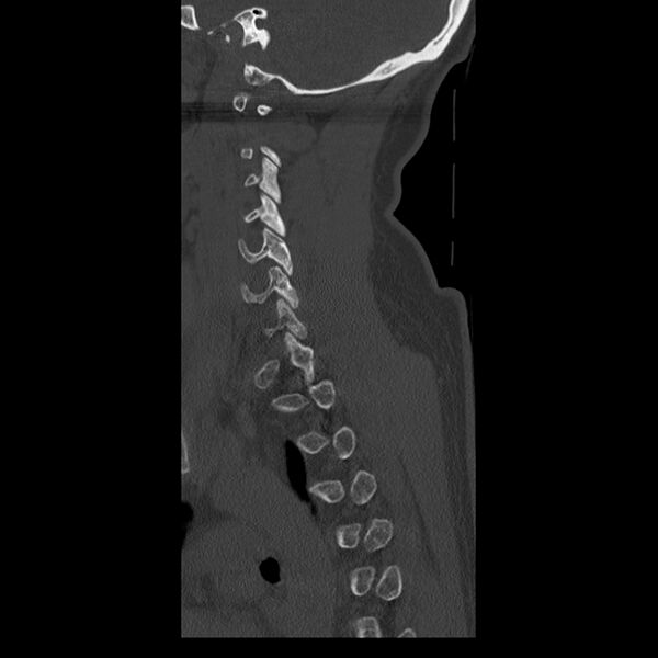File:Occipital condyle fracture (Radiopaedia 31755-32691 Sagittal bone window 32).jpg