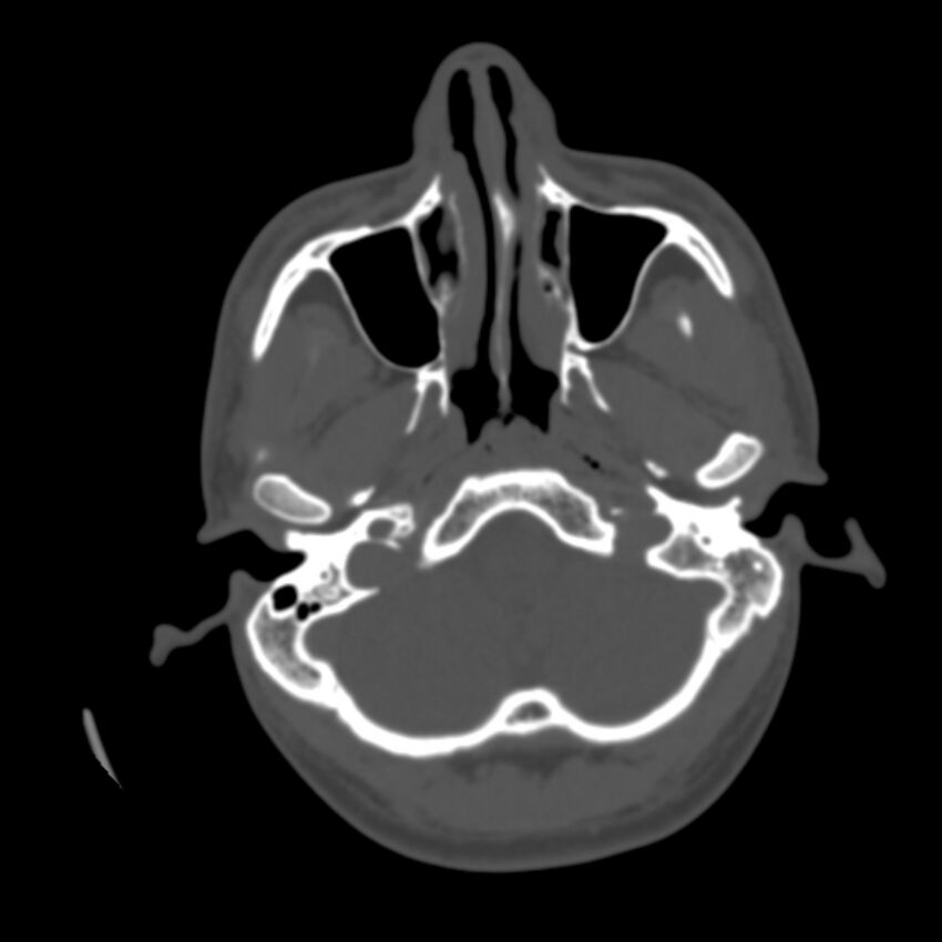 Occipital spur - asymptomatic (Radiopaedia 87753-104201 Axial bone window 18).jpg