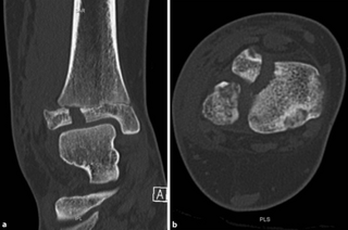 a,b)CT scan, coronal and axial plane of a Tillaux fracture in a male