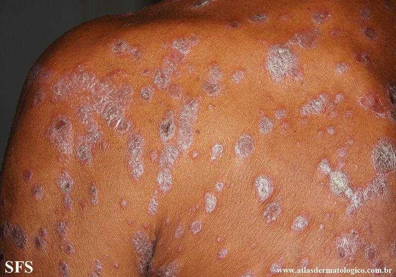 File:Psoriasis (Dermatology Atlas 140).jpg