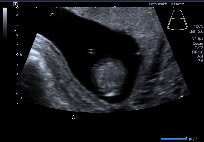 File:1st trimester nuchal-morphology ultrasound (Radiopaedia 44706-48477 General anatomy and NT 44).jpg