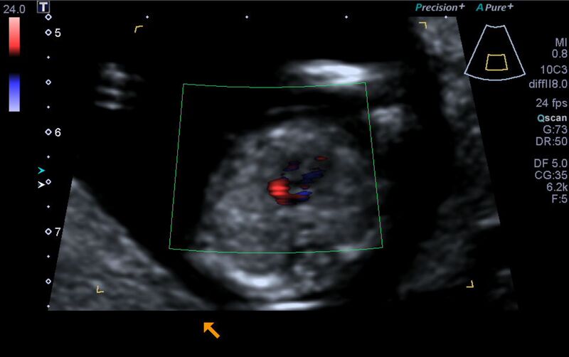 File:1st trimester nuchal-morphology ultrasound (Radiopaedia 44706-48477 Heart views cine with colour 116).jpg