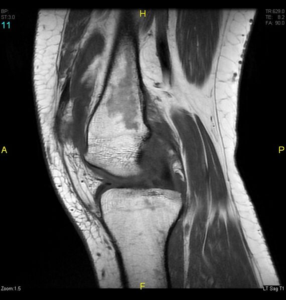 File:ACL mucoid degeration with cystic changes (Radiopaedia 48428-53341 Sagittal T1 9).jpg