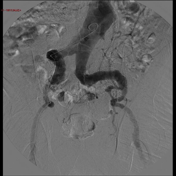 File:Abdominal aortic aneurysm (Radiopaedia 16155-15833 Frontal Aorta 8).jpg