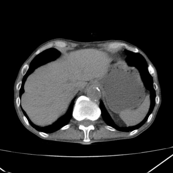 File:Abdominal aortic aneurysm (Radiopaedia 23703-23856 Axial non-contrast 8).jpg