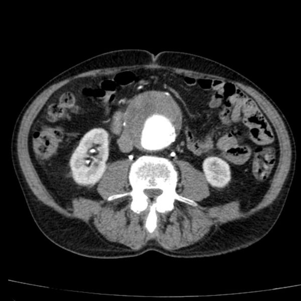 File:Abdominal aortic aneurysm (Radiopaedia 29248-29660 Axial C+ arterial phase 46).jpg