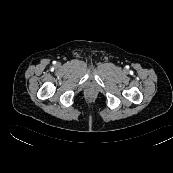 File:Abdominal aortic aneurysm (Radiopaedia 75131-86203 Axial C+ arterial phase 50).jpg