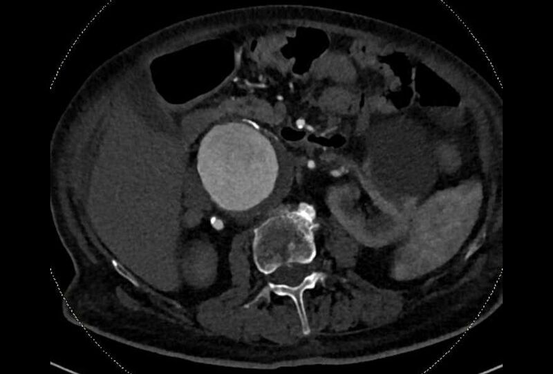 File:Abdominal aortic aneurysm with thrombus fissuration (Radiopaedia 73192-83919 Axial C+ arterial phase 62).jpg