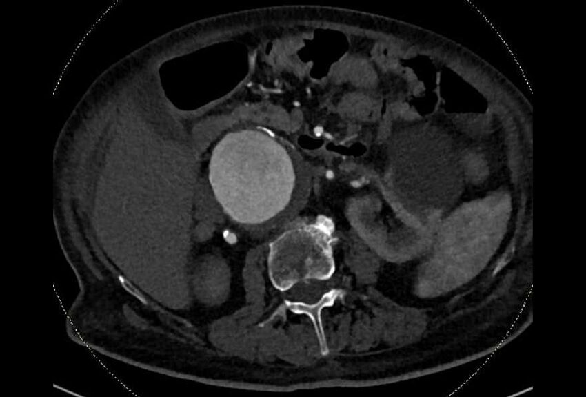 Abdominal aortic aneurysm with thrombus fissuration (Radiopaedia 73192-83919 Axial C+ arterial phase 62).jpg