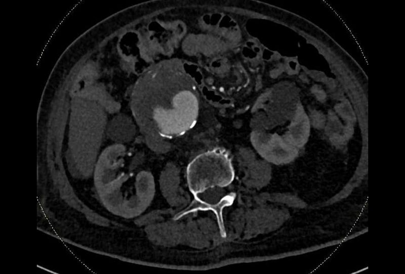 File:Abdominal aortic aneurysm with thrombus fissuration (Radiopaedia 73192-83919 Axial C+ arterial phase 89).jpg
