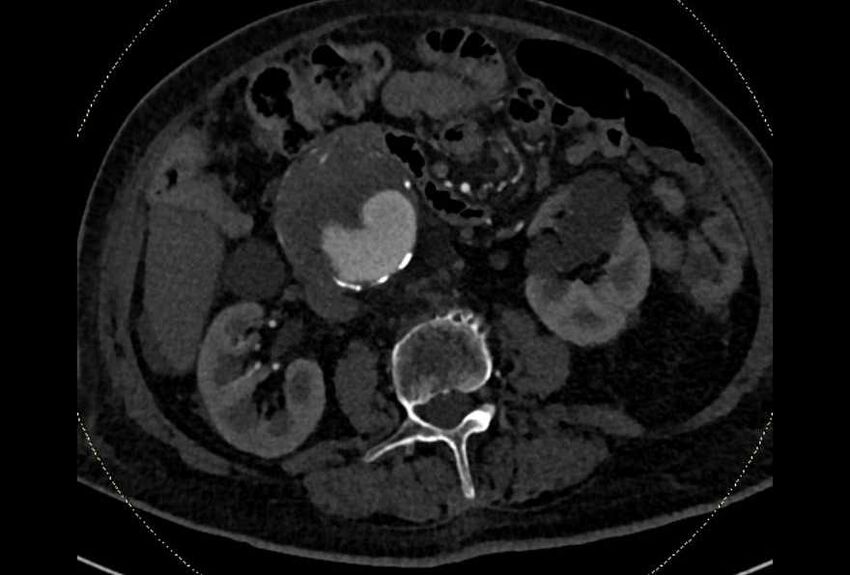 Abdominal aortic aneurysm with thrombus fissuration (Radiopaedia 73192-83919 Axial C+ arterial phase 89).jpg