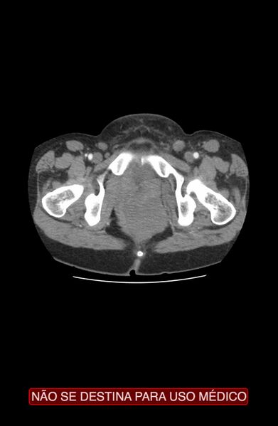 File:Abdominal desmoid tumor (Radiopaedia 44024-47540 Axial C+ arterial phase 55).jpg