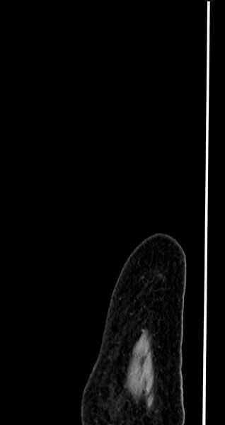 File:Abdominal wall and retroperitoneal tuberculosis (Radiopaedia 88137-104729 Sagittal C+ portal venous phase 4).jpg