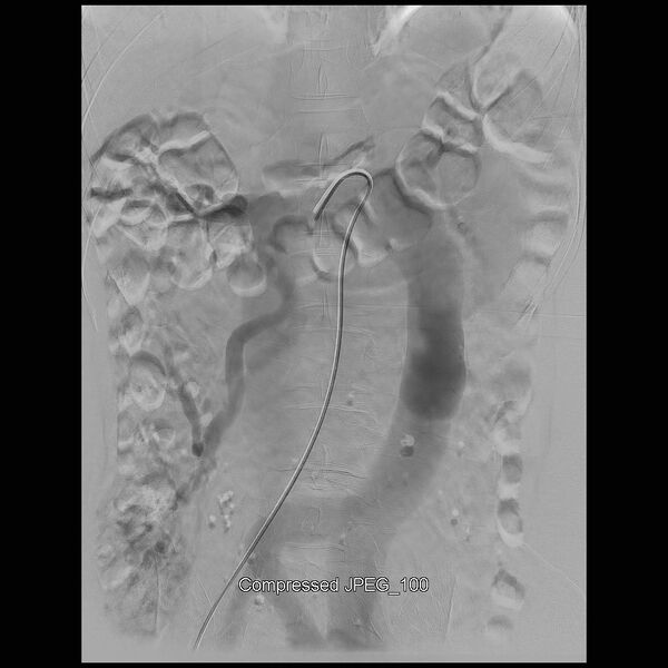 File:Abernethy malformation (Radiopaedia 42006-45462 Frontal Superior mesenteric artery 18).jpg