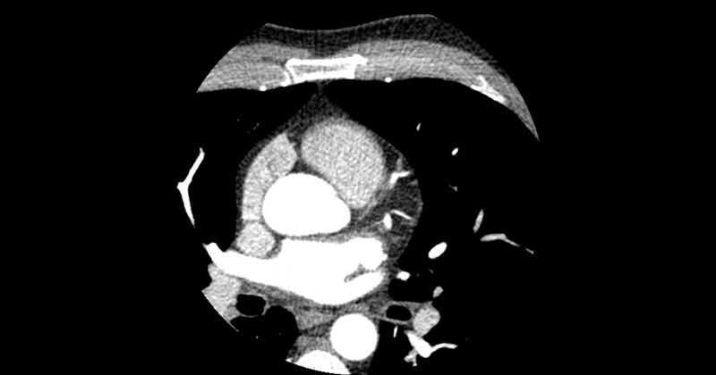 File:Aberrant left main coronary artery (ALMCA) arising from the right sinus with interarterial course (Radiopaedia 63251-71814 Axial C+ arterial phase 55).JPG