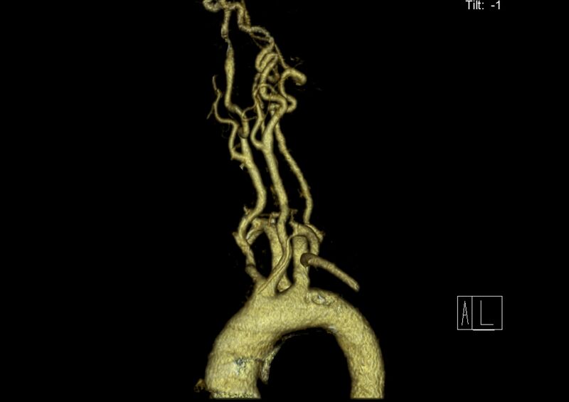 File:Aberrant right subclavian artery (Radiopaedia 19283-19294 3D reconstruction C+ arterial phase 12).jpg