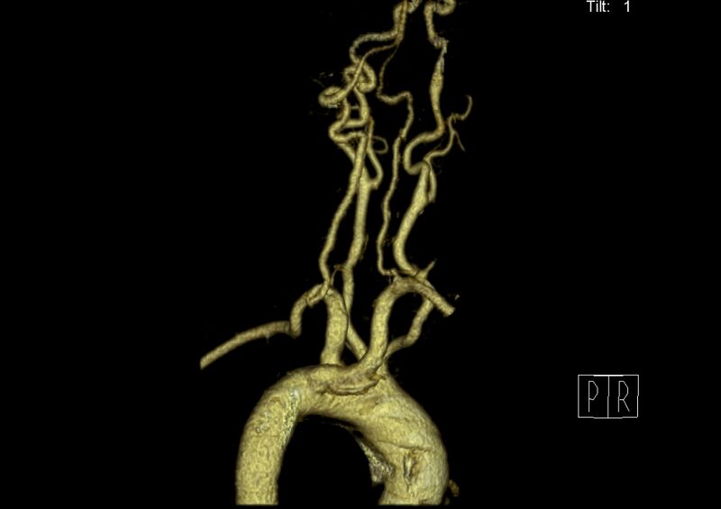 File:Aberrant right subclavian artery (Radiopaedia 19283-19294 3D reconstruction C+ arterial phase 26).jpg