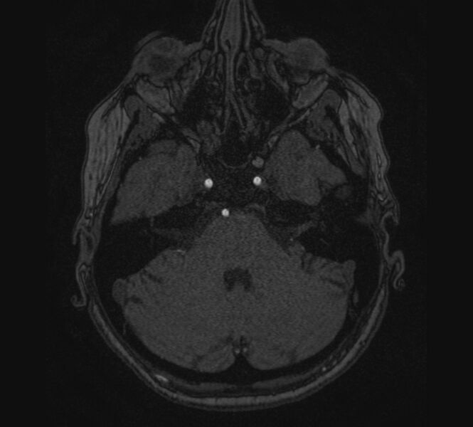 File:Accessory middle cerebral artery and ICA aneurysm (Radiopaedia 22656-22674 MRA 10).jpg