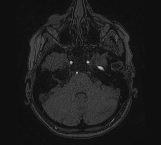 File:Accessory middle cerebral artery and ICA aneurysm (Radiopaedia 22656-22674 MRA 4).jpg