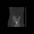 Acetabular fracture (Radiopaedia 13193-13212 Sagittal bone window 1).jpg