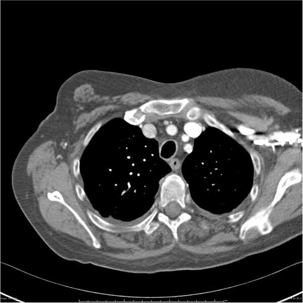 File:Acute-on-chronic pulmonary emboli (Radiopaedia 27925-28169 C+ CTPA 16).jpg