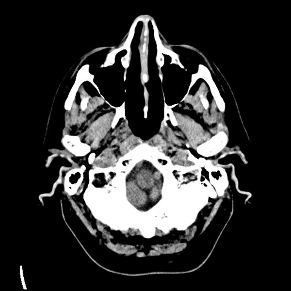 File:Acute A3 occlusion with ACA ischemic penumbra (CT perfusion) (Radiopaedia 72036-82525 Axial non-contrast 3).jpg