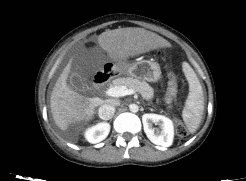 Acute Budd-Chiari syndrome (Radiopaedia 60858-68638 Axial C+ portal venous phase 109).jpg