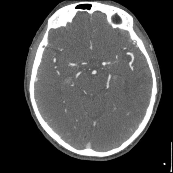 File:Acute P1 occlusion with PCA ischemia penumbra (CT perfusion) (Radiopaedia 72084-82587 Axial C+ arterial thins 32).jpg