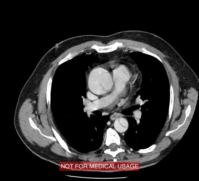 File:Acute aortic dissection - Stanford type A (Radiopaedia 40661-43285 Axial C+ portal venous phase 23).jpg