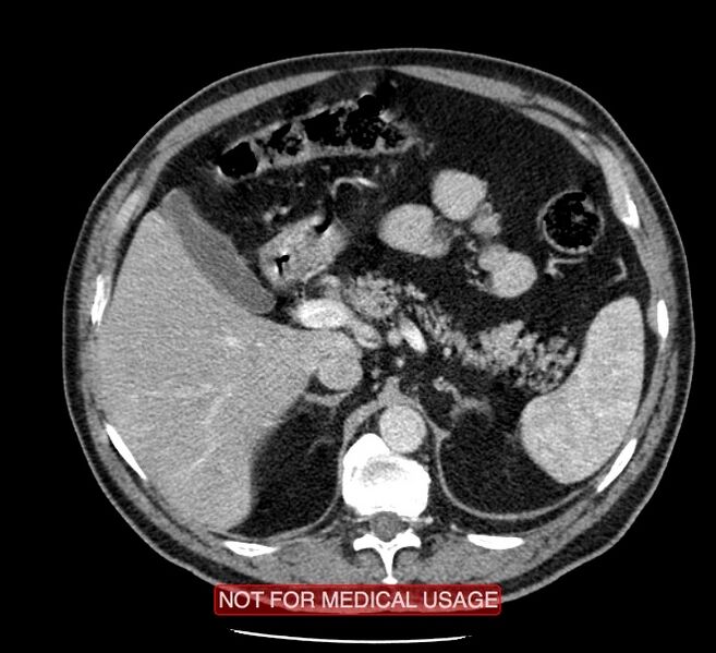 File:Acute aortic dissection - Stanford type A (Radiopaedia 40661-43285 Axial C+ portal venous phase 79).jpg