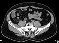 Acute appendicitis (Radiopaedia 13030-13091 Axial non-contrast 19).jpg