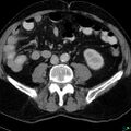 Acute appendicitis arising from a malrotated cecum (Radiopaedia 19970-19997 Axial C+ portal venous phase 21).jpg