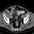 Acute appendicitis arising from a malrotated cecum (Radiopaedia 19970-19997 Axial C+ portal venous phase 41).jpg