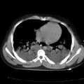 Acute aspiration pneumonitis (Radiopaedia 33605-34703 Axial non-contrast 56).jpg