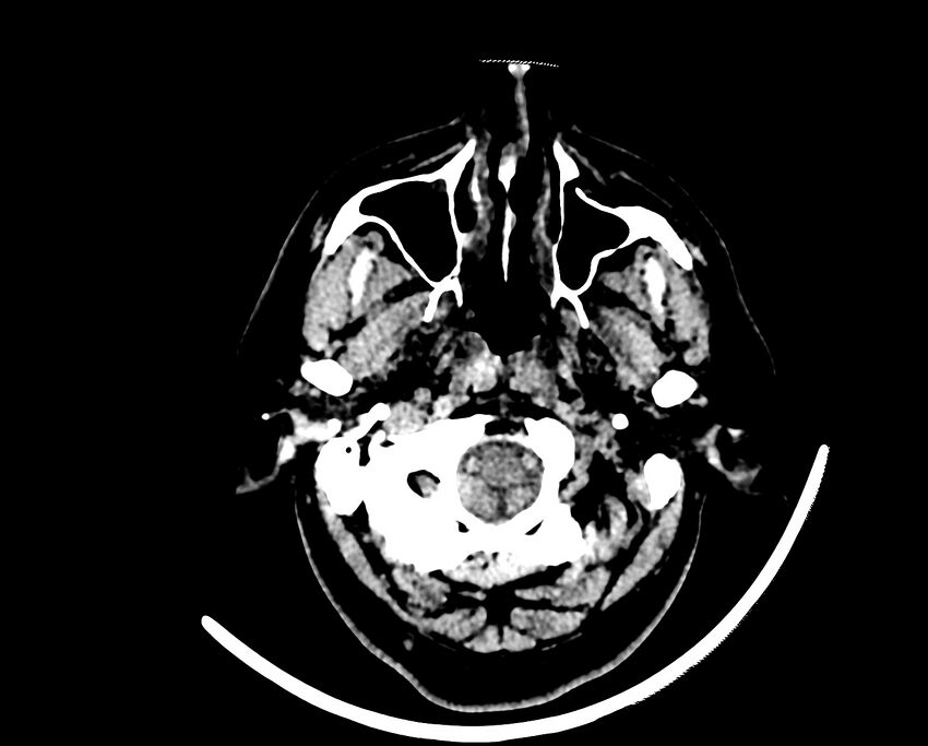 Acute cerebral infarct (Radiopaedia 35604-37123 Axial non-contrast 6).jpg