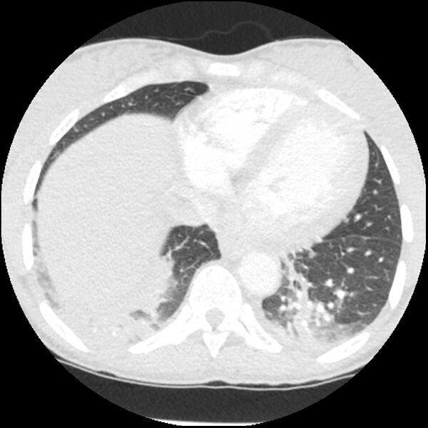 File:Acute chest syndrome - sickle cell disease (Radiopaedia 42375-45499 Axial lung window 145).jpg