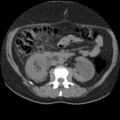 Acute cholecystitis and ureteric colic (Radiopaedia 42330-45444 Axial prone 41).jpg