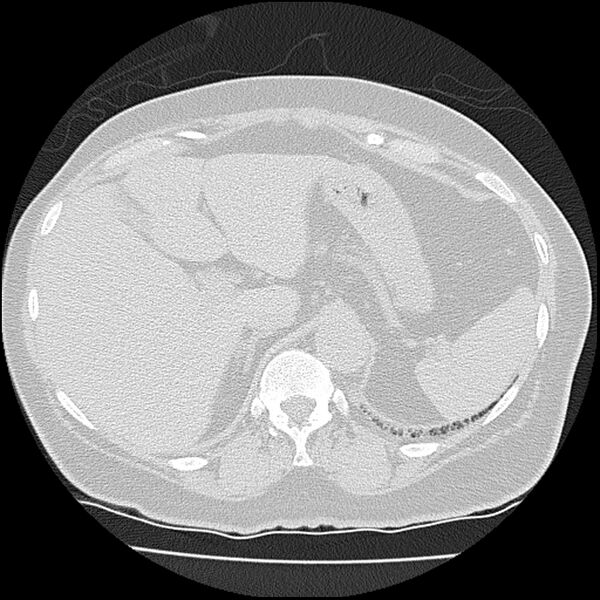 File:Acute interstitial pneumonitis (Radiopaedia 45404-49452 Axial lung window 89).jpg