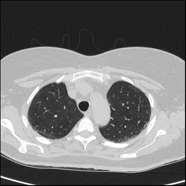 File:Acute interstitial pneumonitis (Radiopaedia 45404-49453 Axial lung window 20).jpg