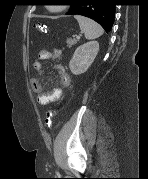 File:Acute mesenteric venous ischemia (Radiopaedia 46041-50383 Sagittal C+ portal venous phase 88).jpg