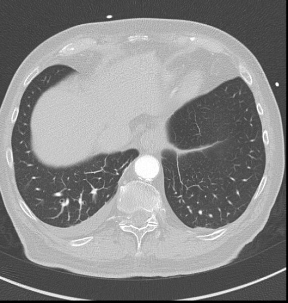File:Acute myocardial infarction (Radiopaedia 23413-23481 lung window 61).jpg