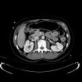 Acute myocardial infarction in CT (Radiopaedia 39947-42415 Axial C+ portal venous phase 50).jpg