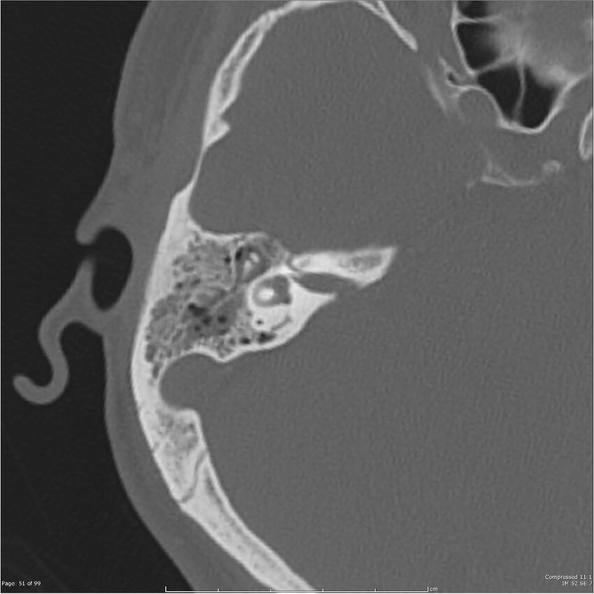 Acute otomastoiditis (Radiopaedia 28276-28512 Axial PTB bone window reformat 31).jpg