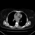 Acute pancreatitis - Balthazar C (Radiopaedia 26569-26714 Axial non-contrast 3).jpg