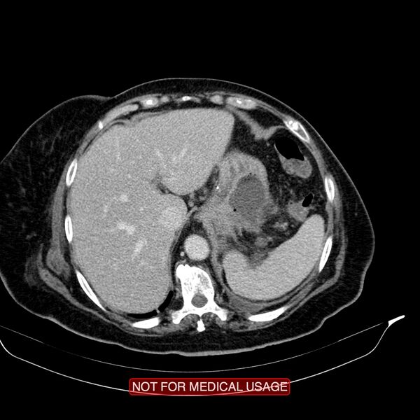 File:Acute pancreatitis with infected necrosis (Radiopaedia 26454-26585 Axial C+ portal venous phase 2).jpg